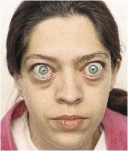 Woman with Graves' disease showing protruding eyeballs (exophthalmos)