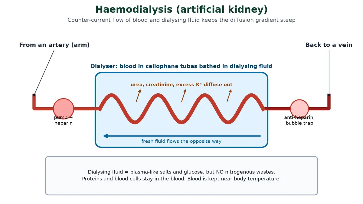 Haemodialysis: blood is taken from an artery in the arm, pumped with heparin through cellophane tubes in a dialyser where urea, creatinine and excess potassium diffuse into dialysing fluid flowing the opposite way, then given anti-heparin and returned to a vein