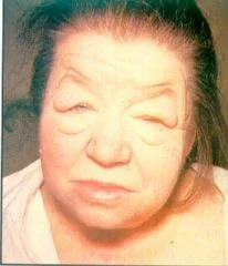 Face of an adult woman with myxoedema showing puffy swollen features caused by hypothyroidism