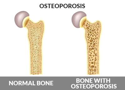 Normal bone compared with porous bone that has lost mineral, as in osteoporosis