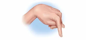 Hand in carpal spasm with flexed wrist and extended fingers, a sign of hypocalcaemic tetany
